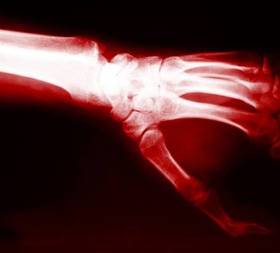 Kéz röntgenképe